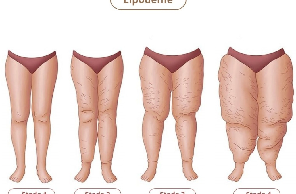 Lipoédème : approche 4-Tech et protocole ERAS pour des résultats naturels et durables