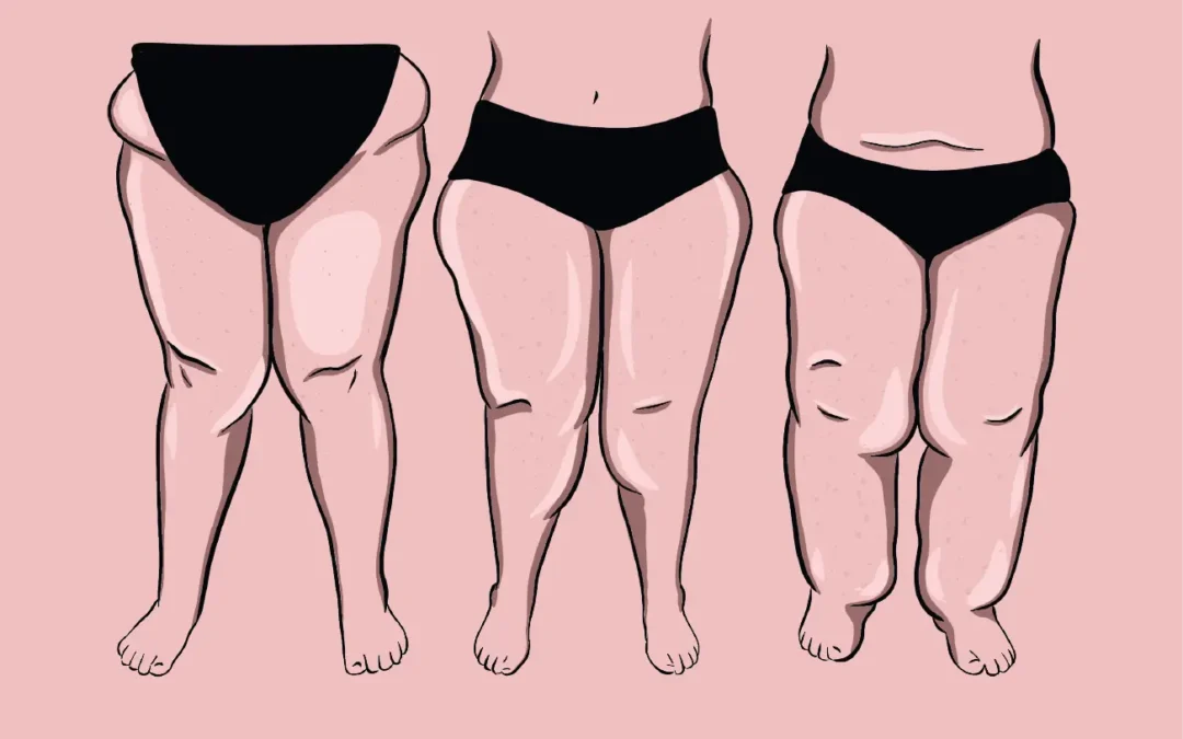 Pourquoi les régimes ne fonctionnent pas sur le lipœdème ?