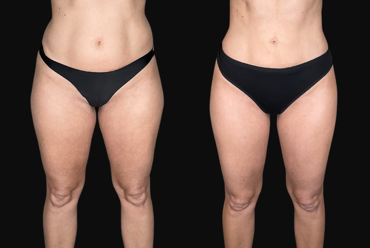 High Definition Lipedema Surgery : expertise avancée pour traiter le lipœdème en Tunisie avec Dr Gam