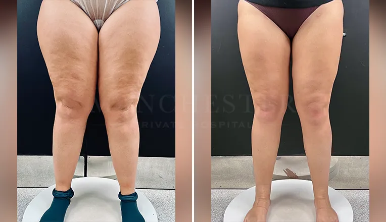 High Definition Lipedema Surgery : expertise avancée pour traiter le lipœdème en Tunisie avec Dr Gam