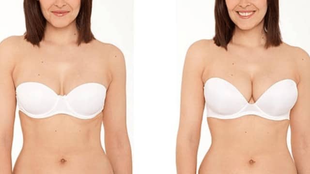 Lipofilling mammaire : chirurgie esthétique des seins au rendu naturel