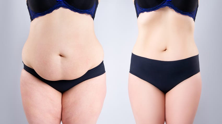 Liposuccion et lifting du corps : une combinaison efficace pour remodeler la silhouette