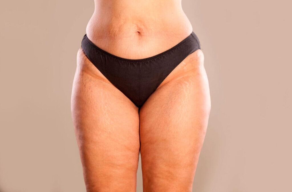 Liposuccion Thérapeutique du Lipœdème en Tunisie : Une Solution Durable contre la Douleur