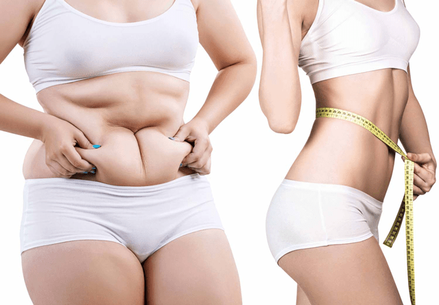 Peut-on associer VASER et abdominoplastie après un traitement du lipœdème ?