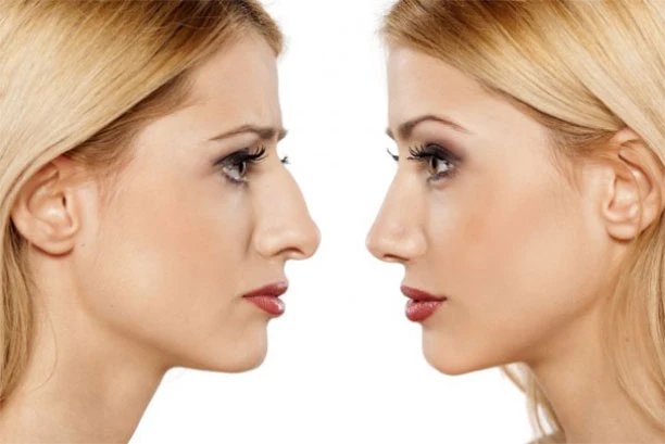 Rhinoplastie de préservation : une approche moderne du remodelage nasal