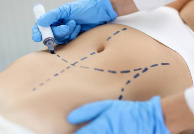 Liposuccion 4D : comment cette technique permet-elle de créer une silhouette athlétique ?