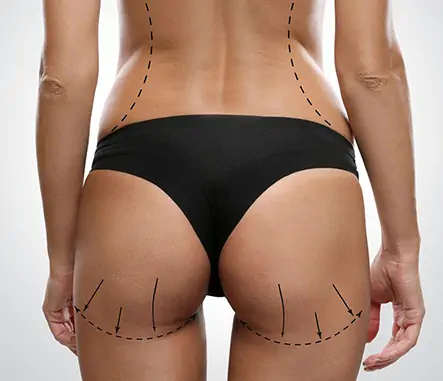 Liposuccion avec augmentation des fesses : la combinaison idéale pour une silhouette harmonieuse