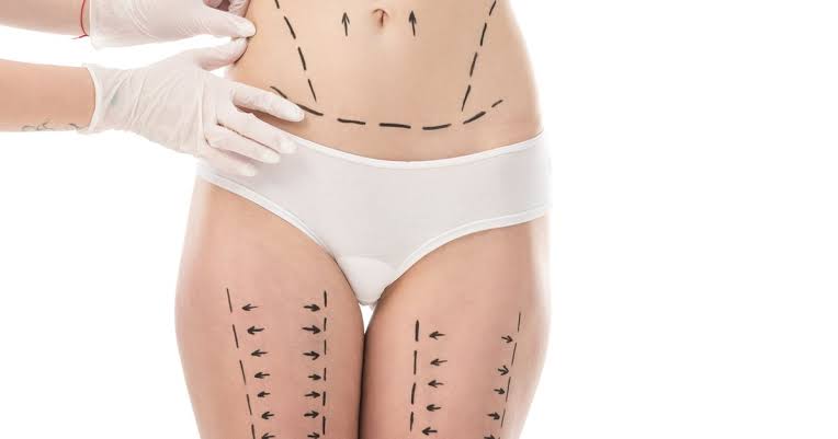 Remodelage du ventre après traitement chirurgical du lipœdème : guide complet