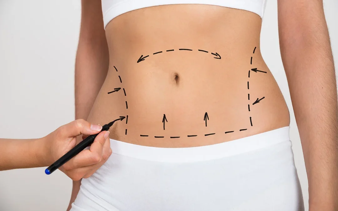 Abdominoplastie avec BodyTite : quelle complémentarité entre chirurgie et raffermissement ?