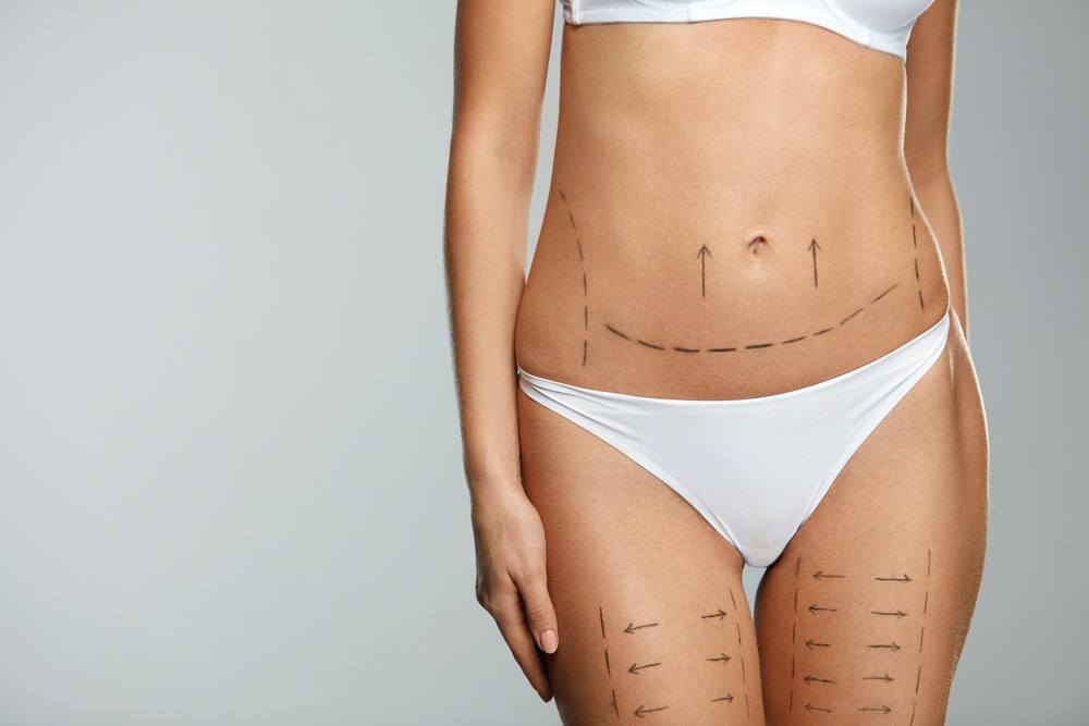 Abdominoplastie et BodyTite : quelle technique choisir pour raffermir et remodeler le ventre ?