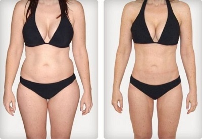 Lifting des cuisses après liposuccion du lipœdème : indications et bénéfices