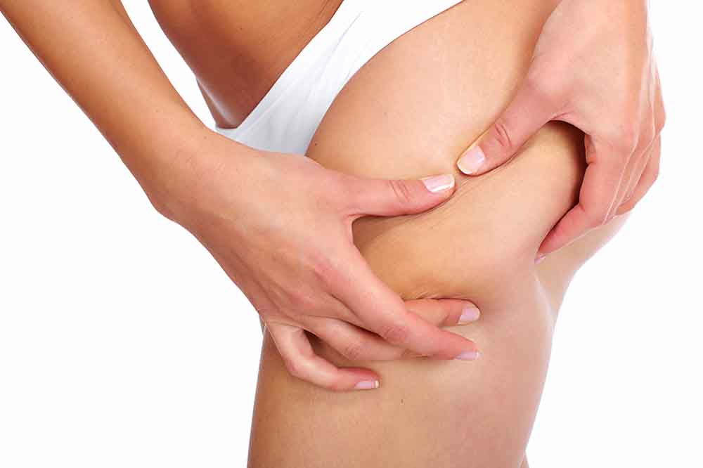 Liposuccion WAL du lipœdème sévère : quels avantages pour les formes avancées ?