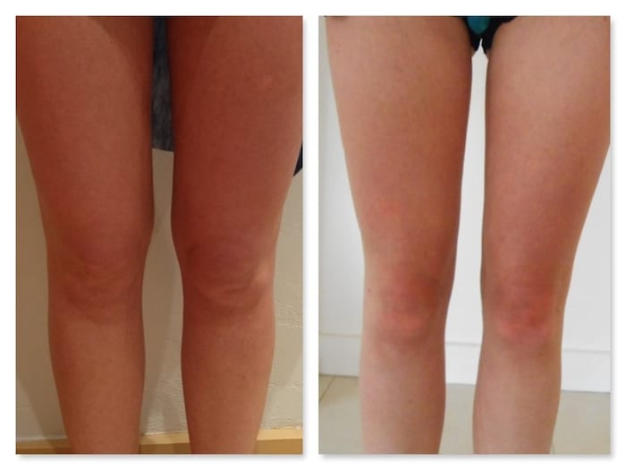 Liposuccion des cuisses et des genoux : quelle combinaison pour affiner les jambes ?