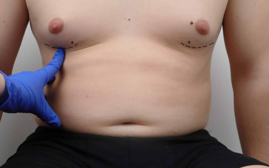 Liposuccion des seins chez l’homme : quelle place dans le traitement de la gynécomastie ?