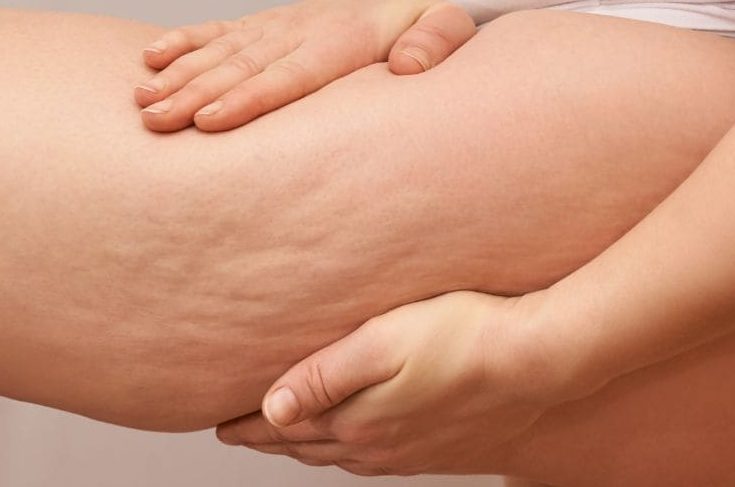 Lipœdème et drainage lymphatique : quel rôle dans la prise en charge ?