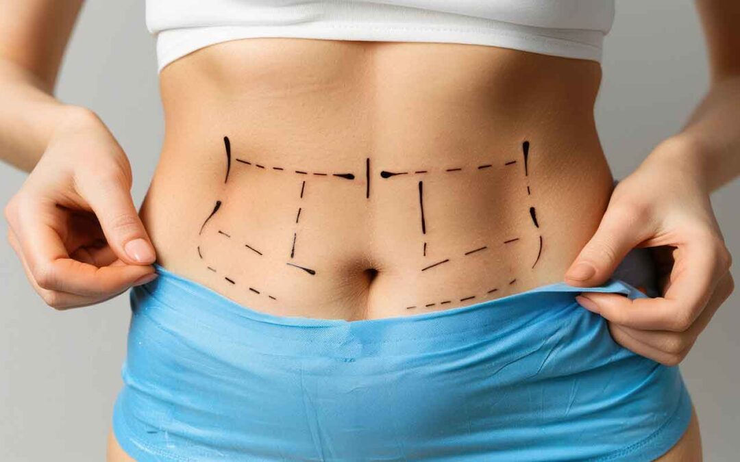 Liposculpture HD avec BodyTite en Tunisie : sculpter la silhouette et raffermir la peau par RFAL avec le Dr GAM