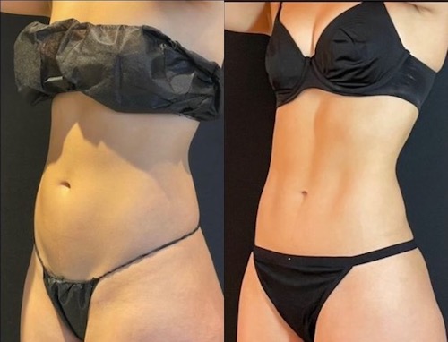 Liposuccion 360° et BBL en Tunisie : une combinaison pour remodeler la silhouette