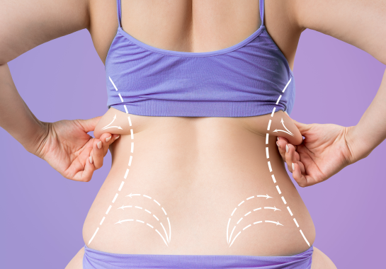 Liposuccion du dos : comment éliminer les bourrelets dorsaux ?