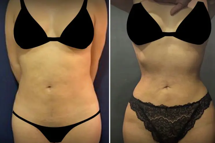 Rib Remodeling et liposuccion 360° : quelles techniques pour affiner la taille et harmoniser la silhouette ?